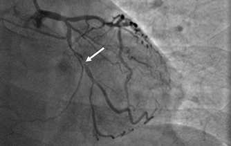 燕達(dá)研究院：成功開展CD19 CAR-T細(xì)胞治療白血病臨床研究